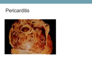 Pericarditis 
 