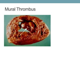 Mural Thrombus 
 