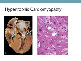 Hypertrophic Cardiomyopathy 
 