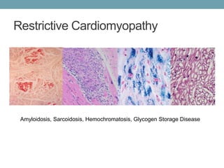 Restrictive Cardiomyopathy 
Amyloidosis, Sarcoidosis, Hemochromatosis, Glycogen Storage Disease 
 