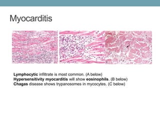 Myocarditis 
Lymphocytic infiltrate is most common. (A below) 
Hypersensitivity myocarditis will show eosinophils. (B below) 
Chagas disease shows trypanosomes in mycocytes. (C below) 
 