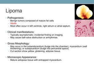 Lipoma 
• Pathogenesis: 
• Benign tumors composed of mature fat cells 
• Adults 
• Most often occur in left ventricle, right atrium or atrial septum. 
• Clinical manifestations: 
• Typically asymptomatic; incidental finding on imaging. 
• May cause ball-valve obstruction or arrhythmias 
• Gross Morphology: 
• May occur in the subendocardium (bulge into the chamber), myocardium (wall 
thickening), or subepicardium (bulge into pericardial space). 
• Cut section show yellow, glistening, adipose tissue. 
• Microscopic Appearance: 
• Mature adiopose tissue with entrapped myocardium. 
 