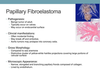 Papillary Fibroelastoma 
• Pathogenesis: 
• Benign tumor of adult. 
• Typically occur on valves 
• May occur on endocardial surface 
• Clincial manifestations: 
• Often incidental finding. 
• May break off and embolize. 
• Aortic tumors may prolapse into coronary ostia. 
• Gross Morphology: 
• Compared to sea anemone 
• Distinctive cluster of yellow-white hairlike projections covering large portions of 
valvular surface 
• Microscopic Appearance: 
• Narrow, elongated and branching papillary fronds composed of collagen. 
• Lined by endothelium. 
 
