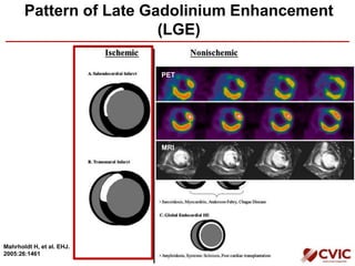 Pattern of Late Gadolinium Enhancement
(LGE)
Mahrholdt H, et al. EHJ.
2005:26:1461
PET
MRI
 