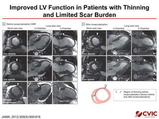 Improved LV Function in Patients with Thinning
and Limited Scar Burden
JAMA. 2013;309(9):909-918
 
