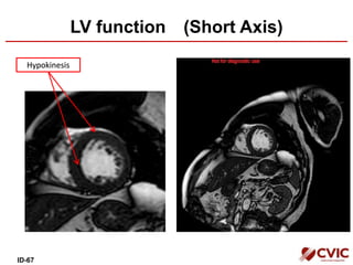 LV function (Short Axis)
HypokinesisHypokinesis
ID-67
 