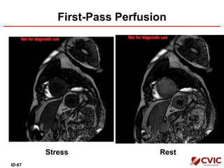 First-Pass Perfusion
Stress Rest
ID-67
 