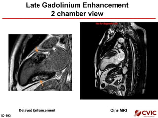 Late Gadolinium Enhancement
2 chamber view
Delayed Enhancement Cine MRI
ID-193
 