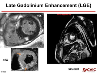 Cine MRI
Late Gadolinium Enhancement (LGE)
LGE
ID-193
T2W
 