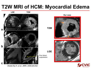 T2W MRI of HCM: Myocardial Edema
Our case
LGE T2W
（Abdel-Aty H, et al. JMRI. 2008;28:242）
LGE
T2W
Poor blood
suppression
 