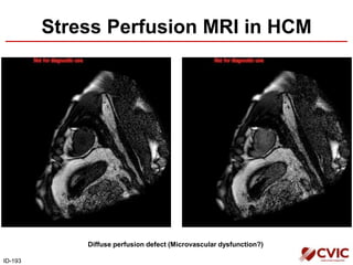 Stress Perfusion MRI in HCM
ID-193
Diffuse perfusion defect (Microvascular dysfunction?)
 