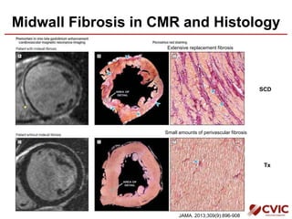 Midwall Fibrosis in CMR and Histology
SCD
Tx
Small amounts of perivascular fibrosis
Extensive replacement fibrosis
JAMA. 2013;309(9):896-908
 