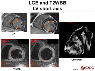 Cine MRI
LGE
ID-416
LGE and T2WBB
LV short axis
T2WBB
 