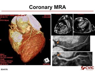 Coronary MRA
ID-6176
LAD
LCX
 