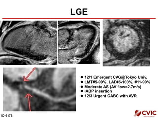 LGE
ID-6176
 12/1 Emergent CAG@Tokyo Univ.
 LMT#5-99%, LAD#6-100%, #11-99%
 Moderate AS (AV flow=2.7m/s)
 IABP insertion
 12/3 Urgent CABG with AVR
 