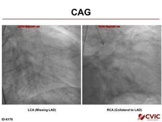 CAG
ID-6176
LCA (Missing LAD) RCA (Collateral to LAD)
 