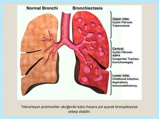 Tekrarlayan pnömoniler akciğerde kalıcı hasara yol açarak bronşektaziye
sebep olabilir.
 
