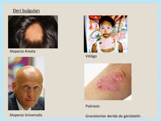 Deri bulguları
Alopecia Areata
Alopecia Universalis
Vitiligo
Psöriasis
Granülomlar deride de görülebilir.
 
