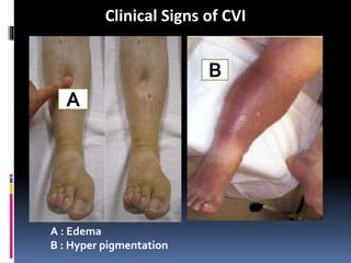 CVI [Recovered] for the management .pptx