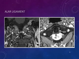 ALAR LIGAMENT
13
 