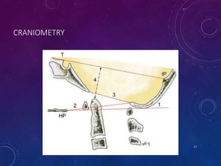 CRANIOMETRY
17
 