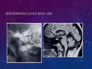 WACKENHEIM CLIVUS BASE LINE
22
 