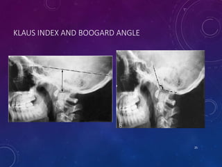 KLAUS INDEX AND BOOGARD ANGLE
25
 