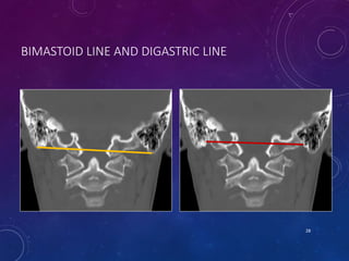 BIMASTOID LINE AND DIGASTRIC LINE
28
 