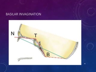 BASILAR INVAGINATION
30
 