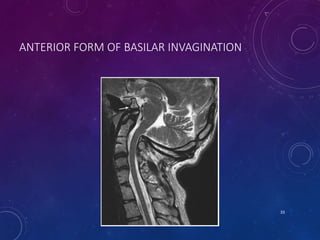 ANTERIOR FORM OF BASILAR INVAGINATION
33
 
