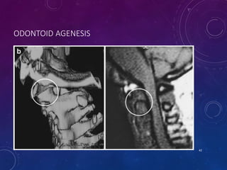 ODONTOID AGENESIS
42
 