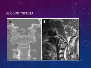 OS ODONTOIDEUM
45
 