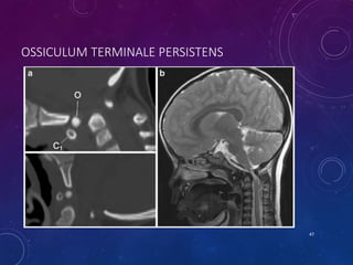 OSSICULUM TERMINALE PERSISTENS
47
 