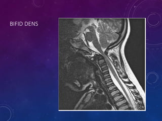 BIFID DENS
52
 