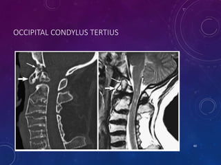 OCCIPITAL CONDYLUS TERTIUS
60
 