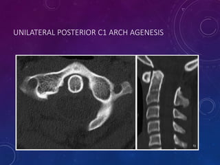 UNILATERAL POSTERIOR C1 ARCH AGENESIS
72
 