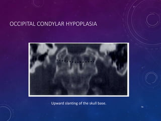 OCCIPITAL CONDYLAR HYPOPLASIA
74
Upward slanting of the skull base.
 