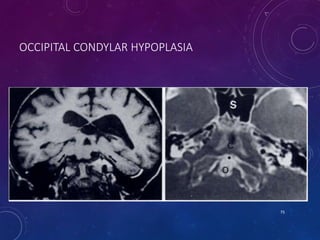 OCCIPITAL CONDYLAR HYPOPLASIA
75
 
