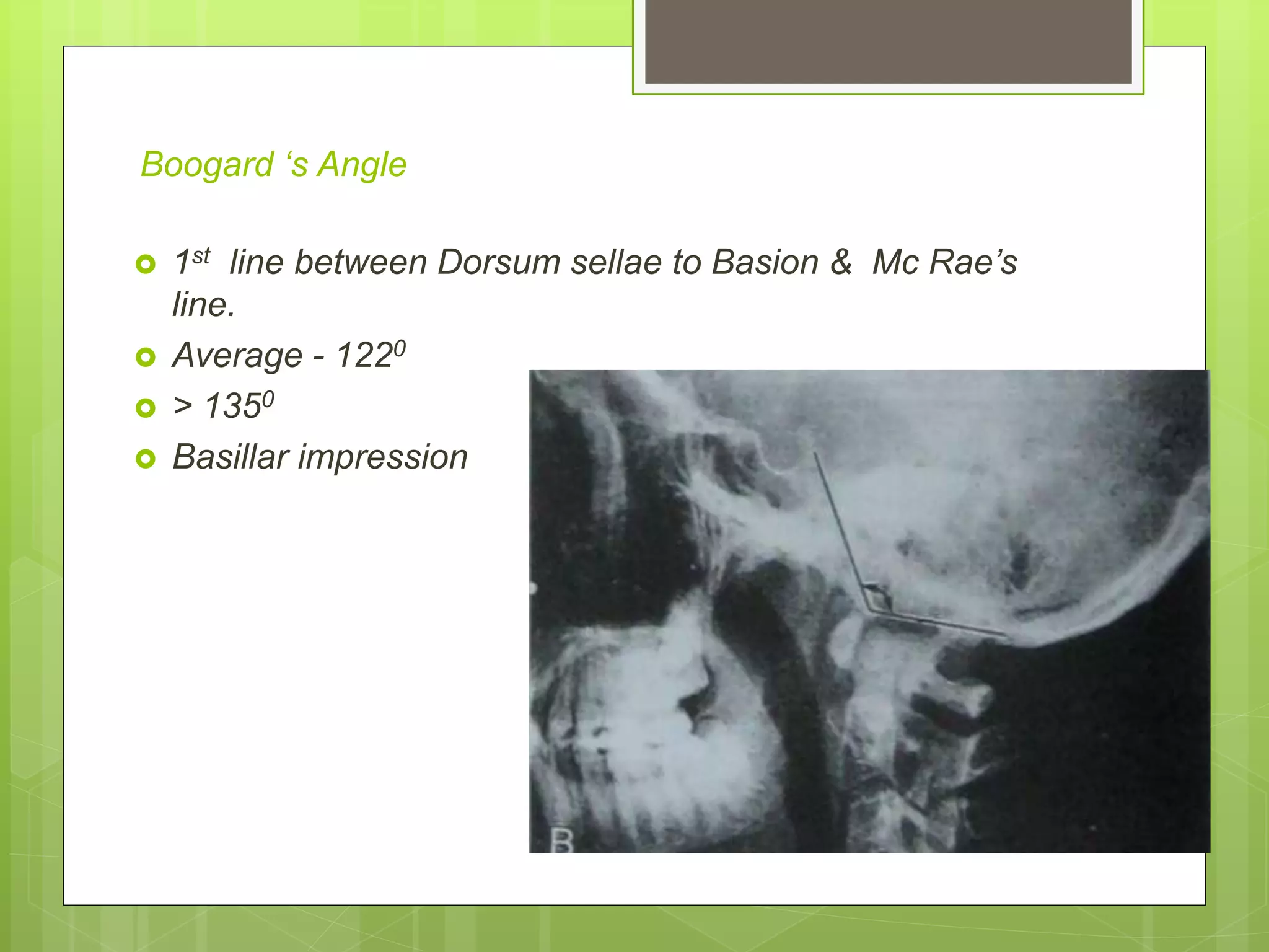 Boogard ‘s Angle
 1st line between Dorsum sellae to Basion & Mc Rae’s
line.
 Average - 1220
 > 1350
 Basillar impression
 