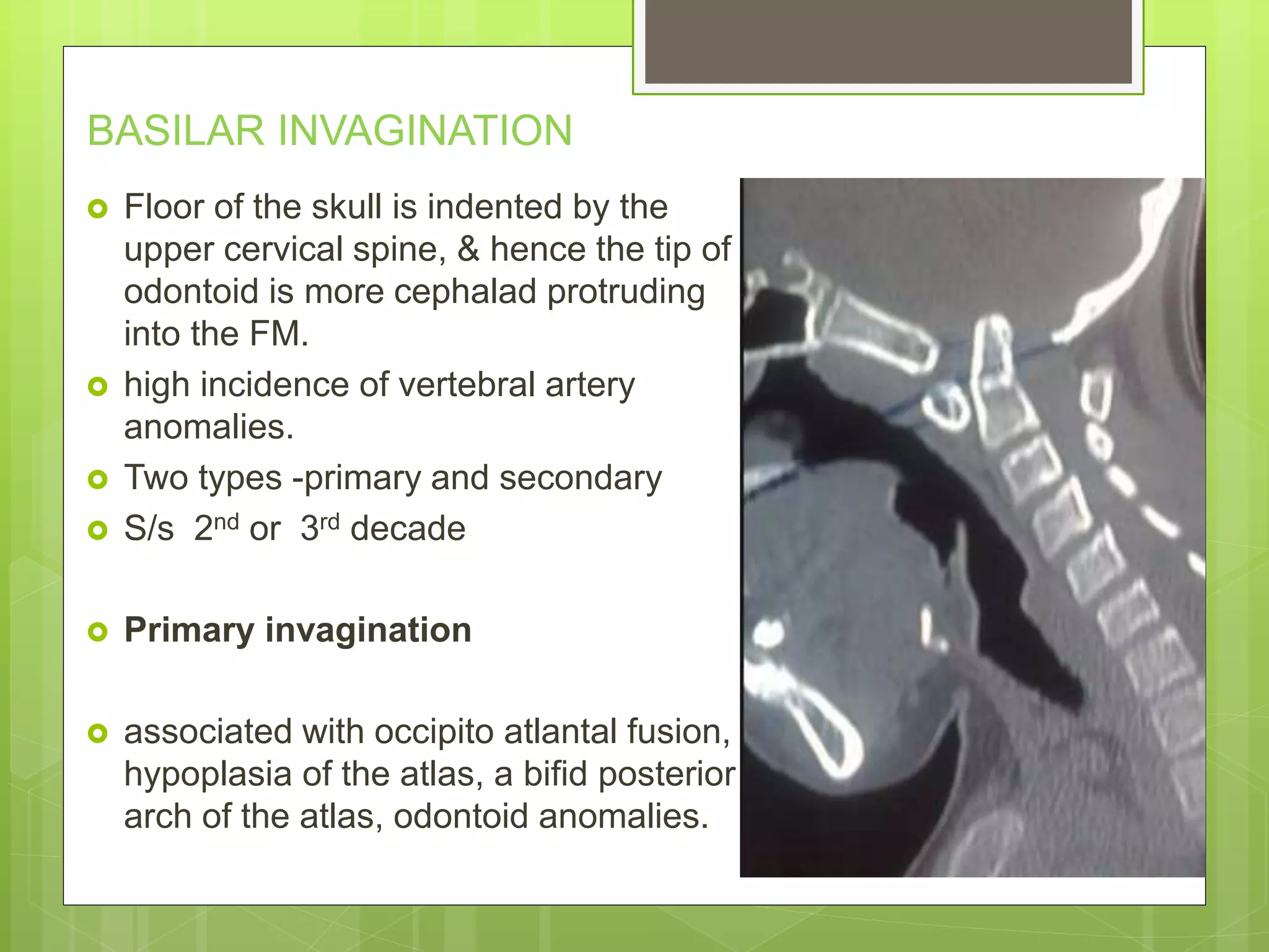 BASILAR INVAGINATION
 Floor of the skull is indented by the
upper cervical spine, & hence the tip of
odontoid is more cephalad protruding
into the FM.
 high incidence of vertebral artery
anomalies.
 Two types -primary and secondary
 S/s 2nd or 3rd decade
 Primary invagination
 associated with occipito atlantal fusion,
hypoplasia of the atlas, a bifid posterior
arch of the atlas, odontoid anomalies.
 