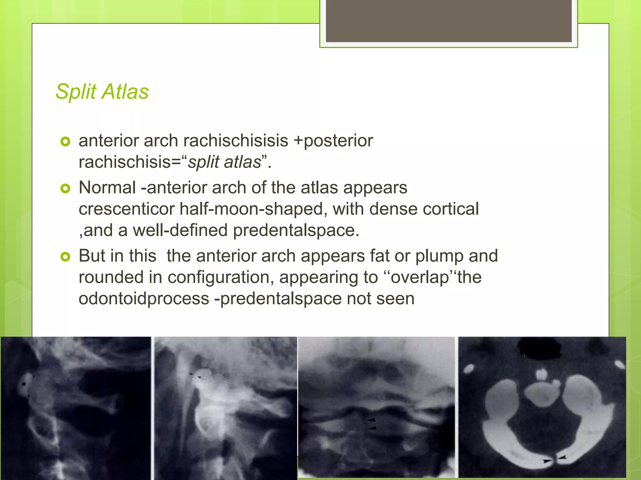 Split Atlas
 anterior arch rachischisisis +posterior
rachischisis=“split atlas”.
 Normal -anterior arch of the atlas appears
crescenticor half-moon-shaped, with dense cortical
,and a well-defined predentalspace.
 But in this the anterior arch appears fat or plump and
rounded in configuration, appearing to ‘‘overlap’‘the
odontoidprocess -predentalspace not seen
 