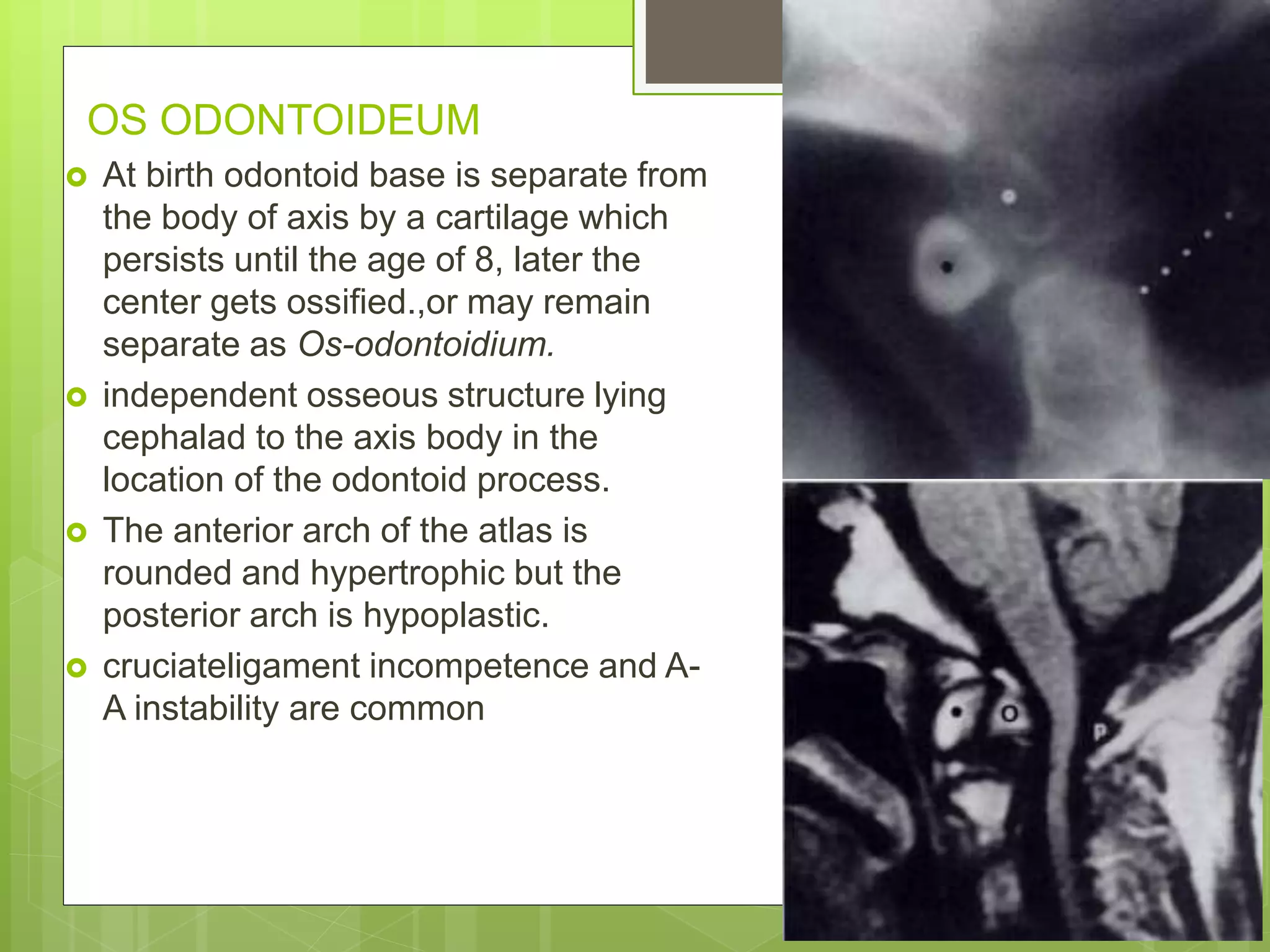 OS ODONTOIDEUM
 At birth odontoid base is separate from
the body of axis by a cartilage which
persists until the age of 8, later the
center gets ossified.,or may remain
separate as Os-odontoidium.
 independent osseous structure lying
cephalad to the axis body in the
location of the odontoid process.
 The anterior arch of the atlas is
rounded and hypertrophic but the
posterior arch is hypoplastic.
 cruciateligament incompetence and A-
A instability are common
 