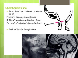 Chamberlain’s line
 From tip of hard palate to posterior
tip of
Foramen Magnum (opisthion).
If Tip of dens below this line ±3 mm
Or >1/3 of odontoid above the line
 Defined basilar Invagination
 