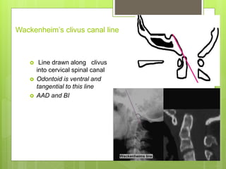 Wackenheim’s clivus canal line
 Line drawn along clivus
into cervical spinal canal
 Odontoid is ventral and
tangential to this line
 AAD and BI
 