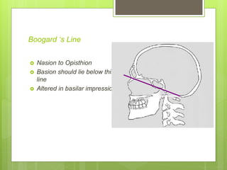 Boogard ‘s Line
 Nasion to Opisthion
 Basion should lie below this
line
 Altered in basilar impression
 