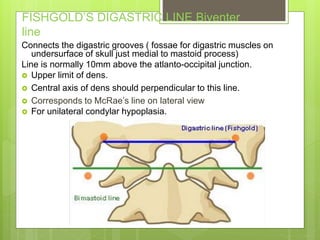 FISHGOLD’S DIGASTRIC LINE Biventer
line
Connects the digastric grooves ( fossae for digastric muscles on
undersurface of skull just medial to mastoid process)
Line is normally 10mm above the atlanto-occipital junction.
 Upper limit of dens.
 Central axis of dens should perpendicular to this line.
 Corresponds to McRae’s line on lateral view
 For unilateral condylar hypoplasia.
 