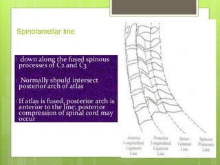 Spinolamellar line
 