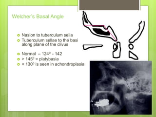 Welcher’s Basal Angle
 Nasion to tuberculum sella
 Tuberculum sellae to the basion
along plane of the clivus
 Normal – 1240 - 142
 > 1450 = platybasia
 < 1300 is seen in achondroplasia
 