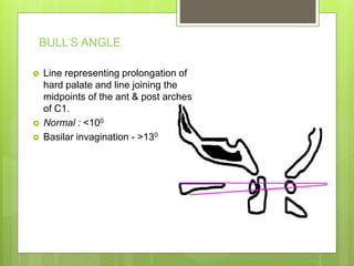 BULL’S ANGLE
 Line representing prolongation of
hard palate and line joining the
midpoints of the ant & post arches
of C1.
 Normal : <100
 Basilar invagination - >130
 