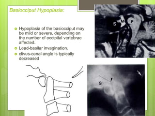 Basiocciput Hypoplasia:
 Hypoplasia of the basiocciput may
be mild or severe, depending on
the number of occipital vertebrae
affected.
 Lead-basilar invagination.
 clivus-canal angle is typically
decreased
 